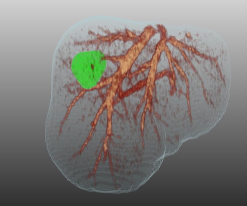 3-D visualization of liver with main venous vascular structures, as well as tumor.
