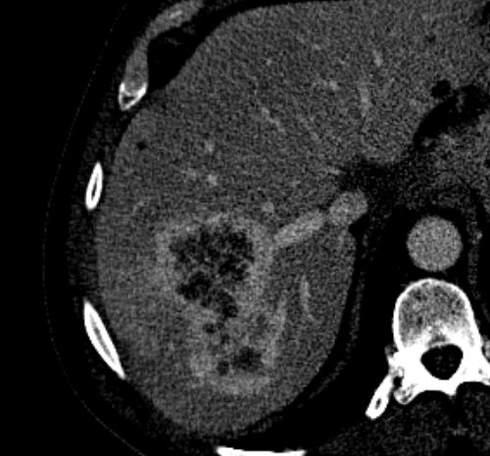 Venous CT image of the liver showing inhomogenous, border enhancing tumor.